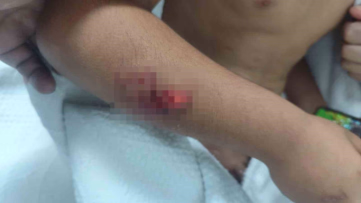 Viranşehir’de köpek saldırısı: Çocuğun başına 15 dikiş